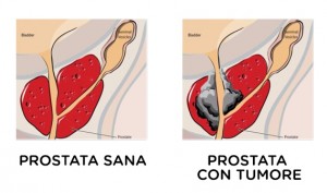 intervento alla prostata a pagamento Prostatitis a vizeletben