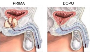 prostate cancer types of surgery