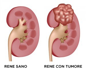 ILTUMORE_DEL_RENE_LA_PATOLOGIA